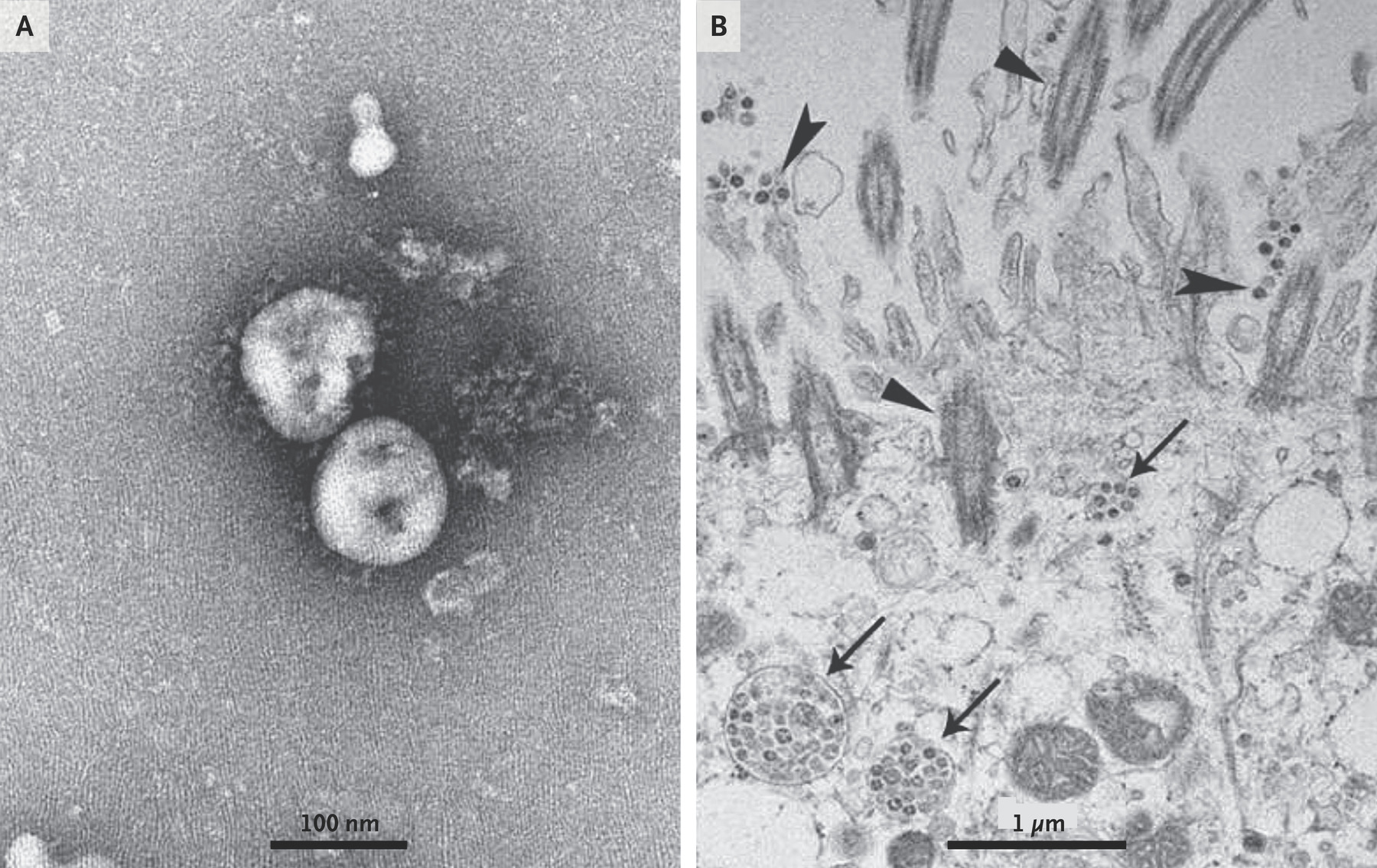 Coronavirus 2019 nCoV with Transmission Electron Microscopy